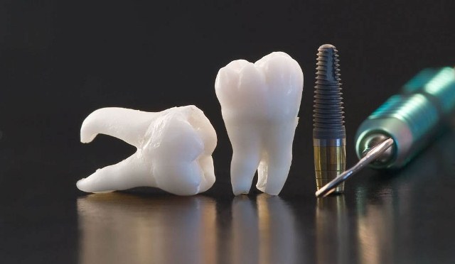 Одноэтапная (моментальная) имплантация – быстрое и эффективное замещение недостающих зубов